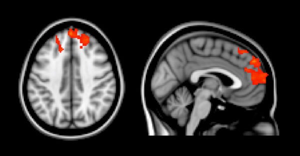 Connections between social and decision-making networks (red spots) typically grow over time, but autistic individuals don’t show this pattern