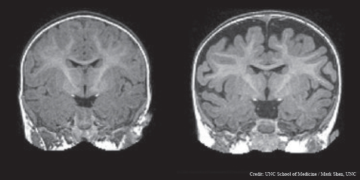 Right: MRI of a baby at 6 months who was diagnosed with autism at 2 years. The dark space between the brain folds and skull indicate increased amounts of cerebrospinal fluid. Left: MRI of a baby who was not diagnosed with autism at age 2.